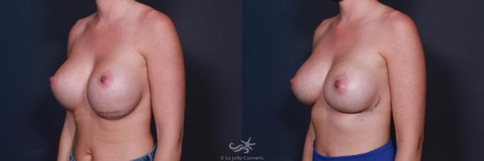 Before & After Breast Augmentation Revision Result 207 Left Oblique View in San Diego, Carlsbad, CA