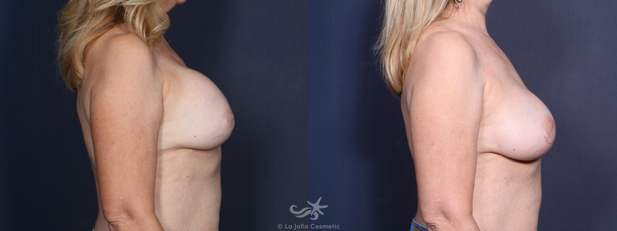 Before & After Breast Augmentation Revision Result 23 Right Side View in San Diego, CA