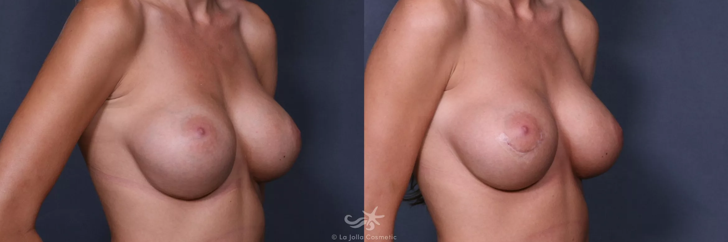 Before & After Breast Augmentation Revision Result 256 Right Oblique View in San Diego, CA