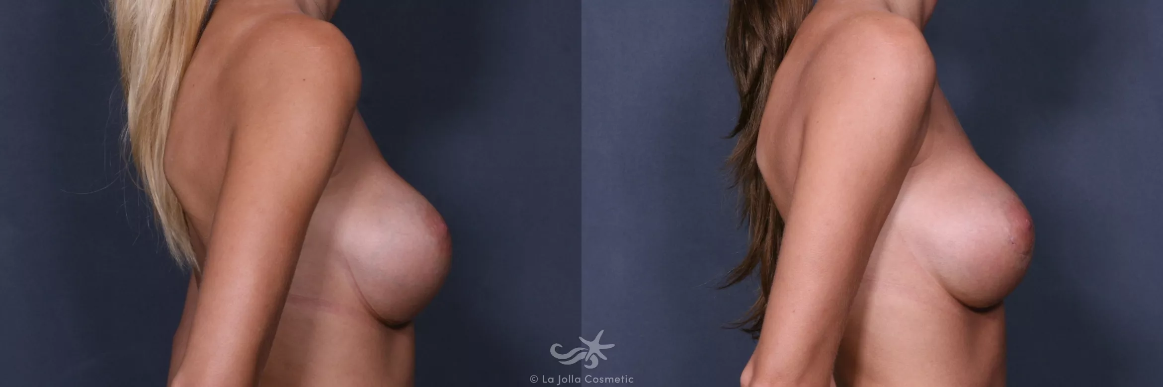 Before & After Breast Augmentation Revision Result 256 Right Side View in San Diego, CA