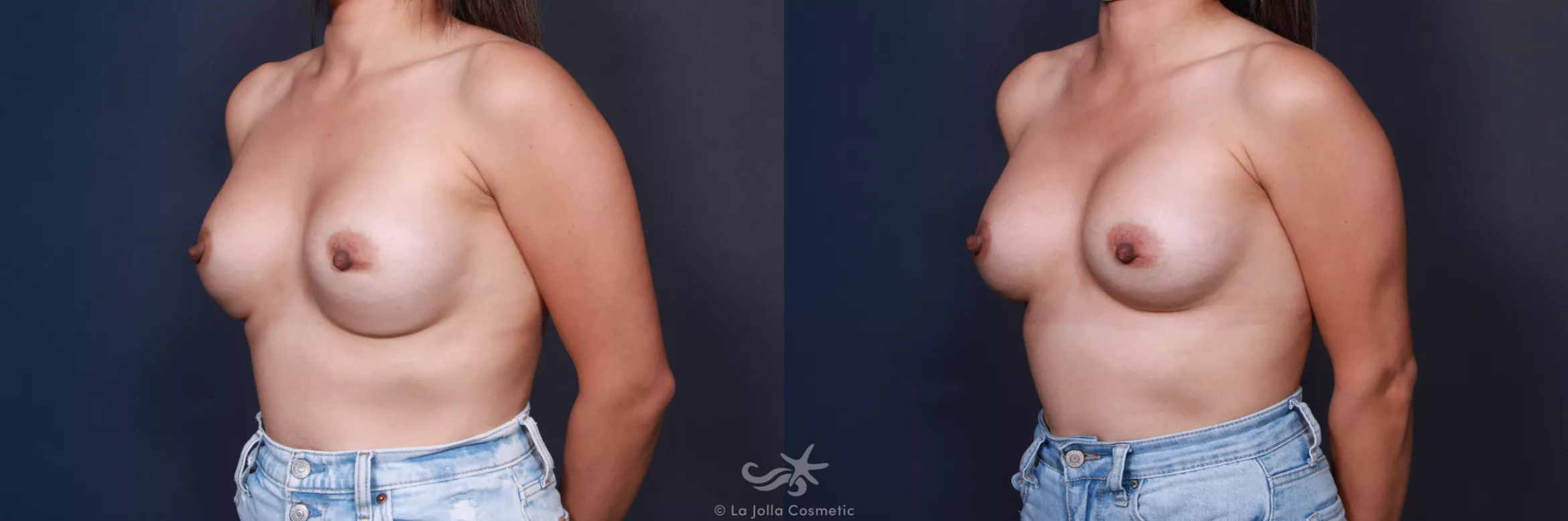 Before & After Breast Augmentation Revision Result 33 Left Oblique View in San Diego, CA