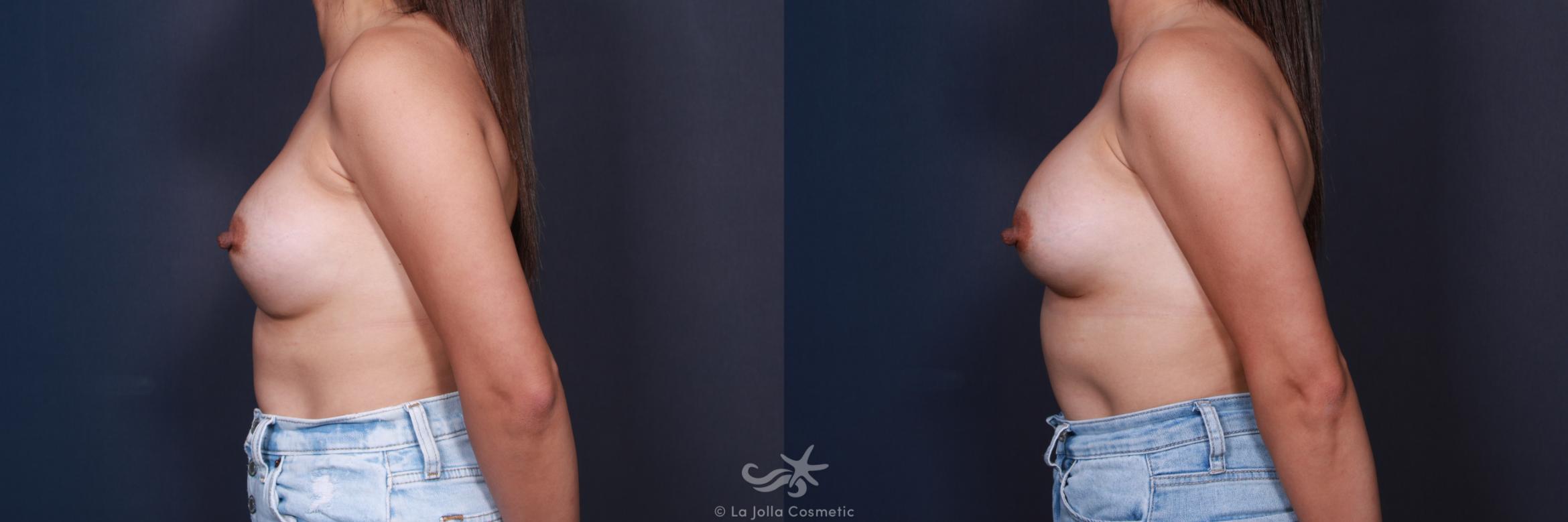 Before & After Breast Augmentation Revision Result 33 Left Side View in San Diego, CA