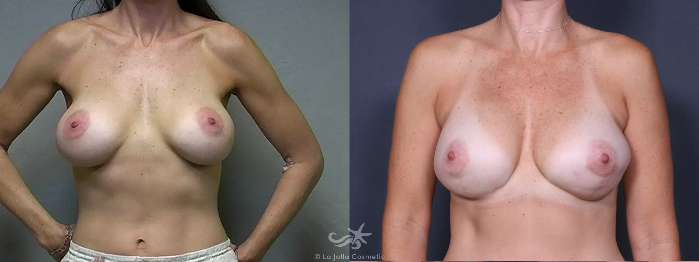 Before & After Breast Augmentation Revision Result 343 Front View in San Diego, CA