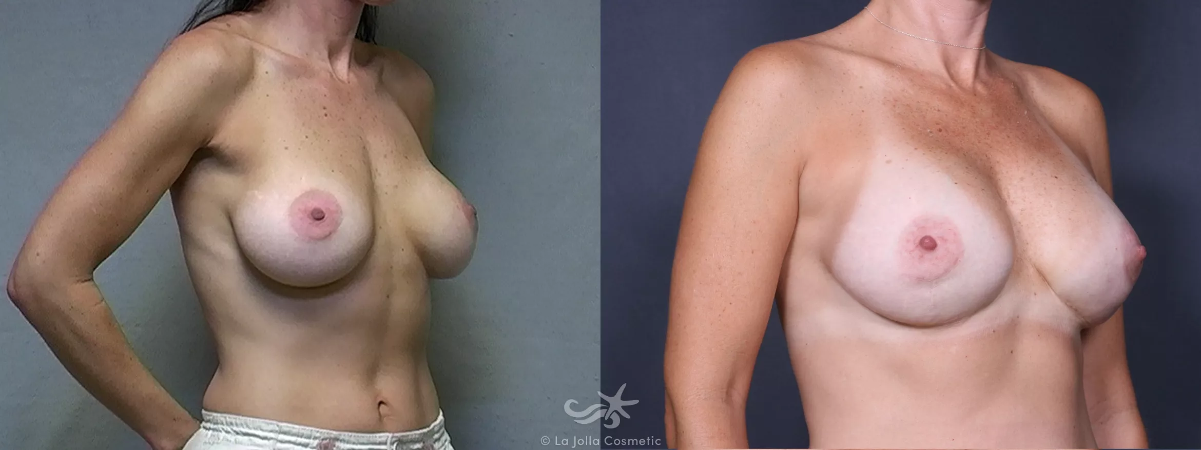 Before & After Breast Augmentation Revision Result 343 Right Oblique View in San Diego, CA