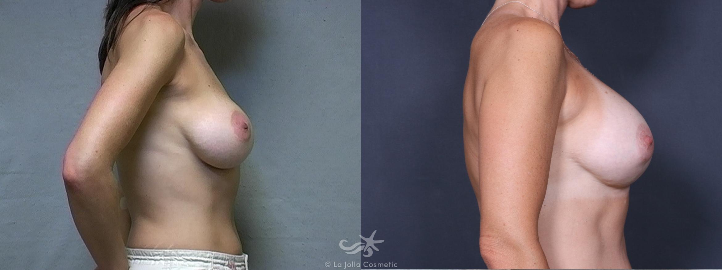 Before & After Breast Augmentation Revision Result 343 Right Side View in San Diego, CA