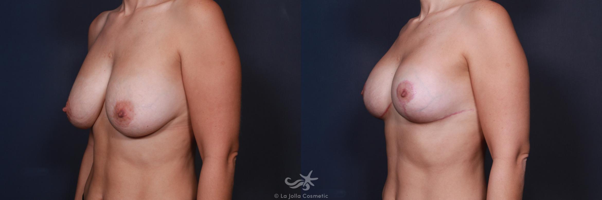 Before & After Breast Augmentation Revision Result 565 Left Oblique View in San Diego, CA
