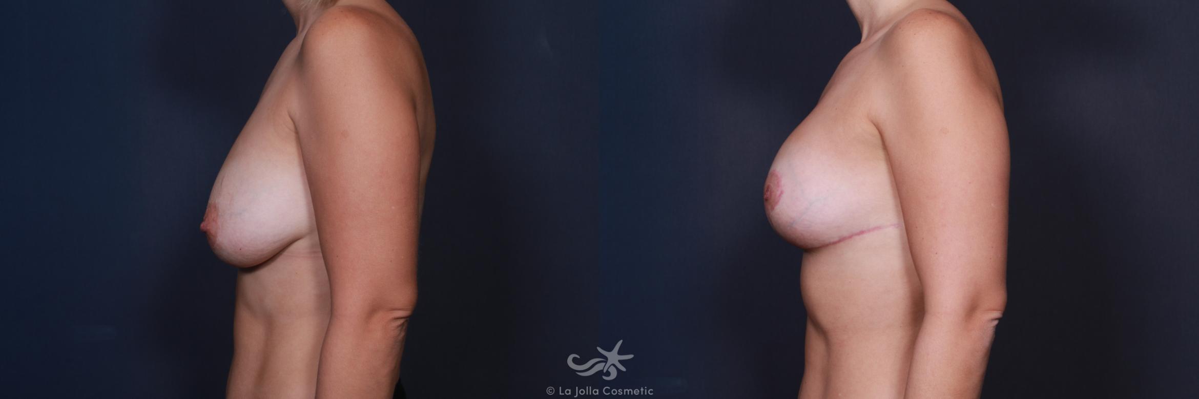 Before & After Breast Augmentation Result 565 Left Side View in San Diego, CA