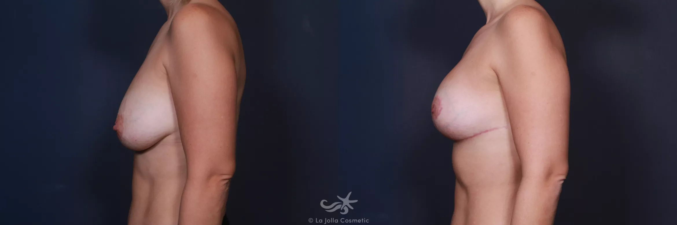 Before & After Breast Augmentation Revision Result 565 Left Side View in San Diego, CA
