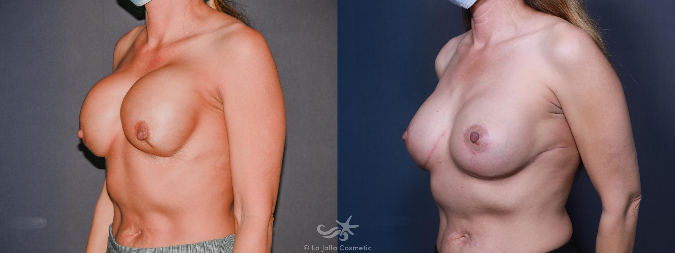 Before & After Breast Augmentation Revision Result 612 Left Oblique View in San Diego, CA