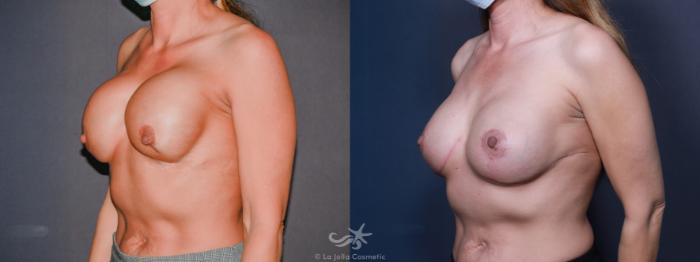 Before & After Breast Augmentation Revision Result 612 Left Oblique View in San Diego, Carlsbad, CA