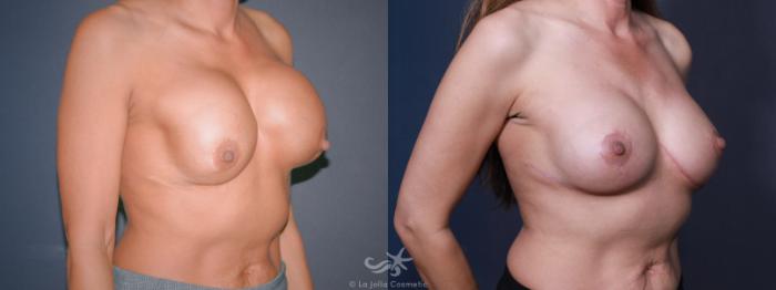 Before & After Breast Augmentation Revision Result 612 Right Oblique View in San Diego, Carlsbad, CA