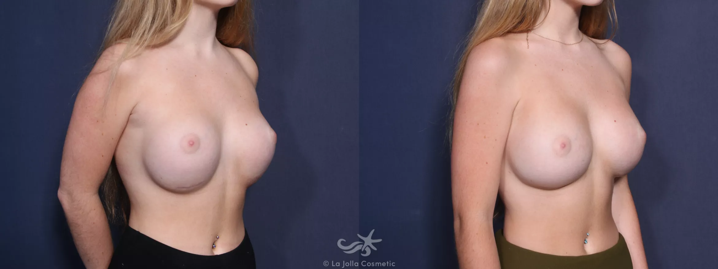 Before & After Breast Augmentation Revision Result 73 Right Oblique View in San Diego, CA