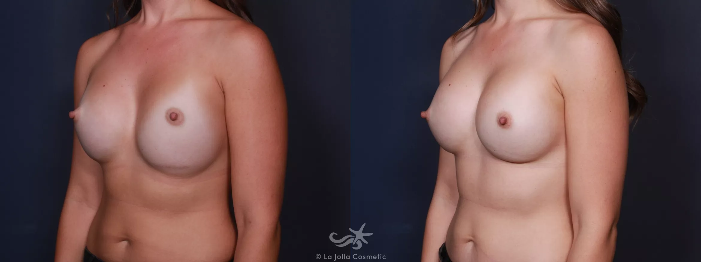 Before & After Breast Augmentation Revision Result 81 Left Oblique View in San Diego, CA