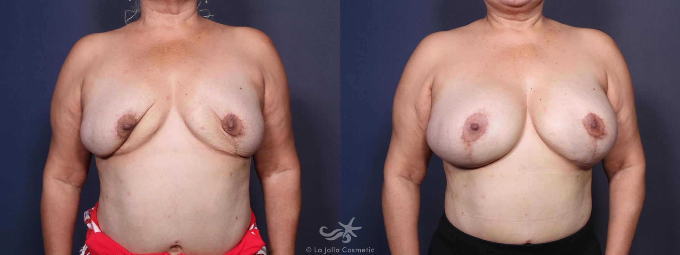 Before & After Breast Augmentation Revision Result 92 Front View in San Diego, CA