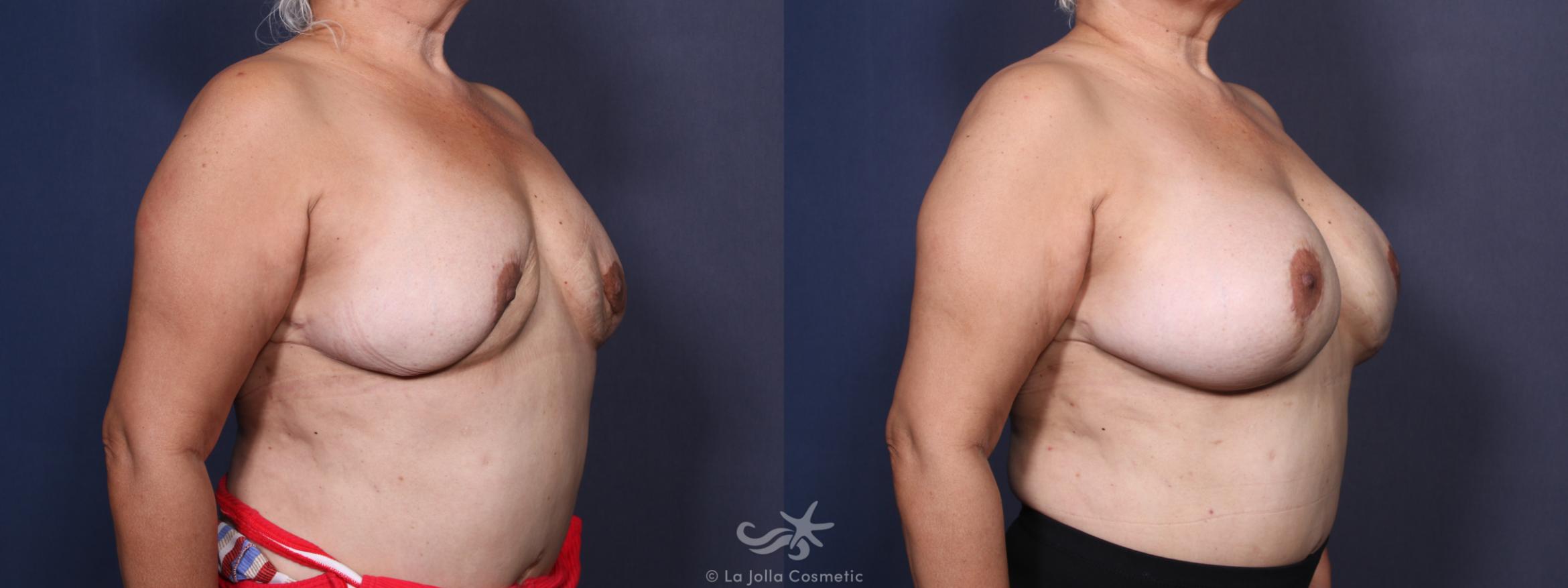 Before & After Breast Augmentation Revision Result 92 Right Oblique View in San Diego, CA