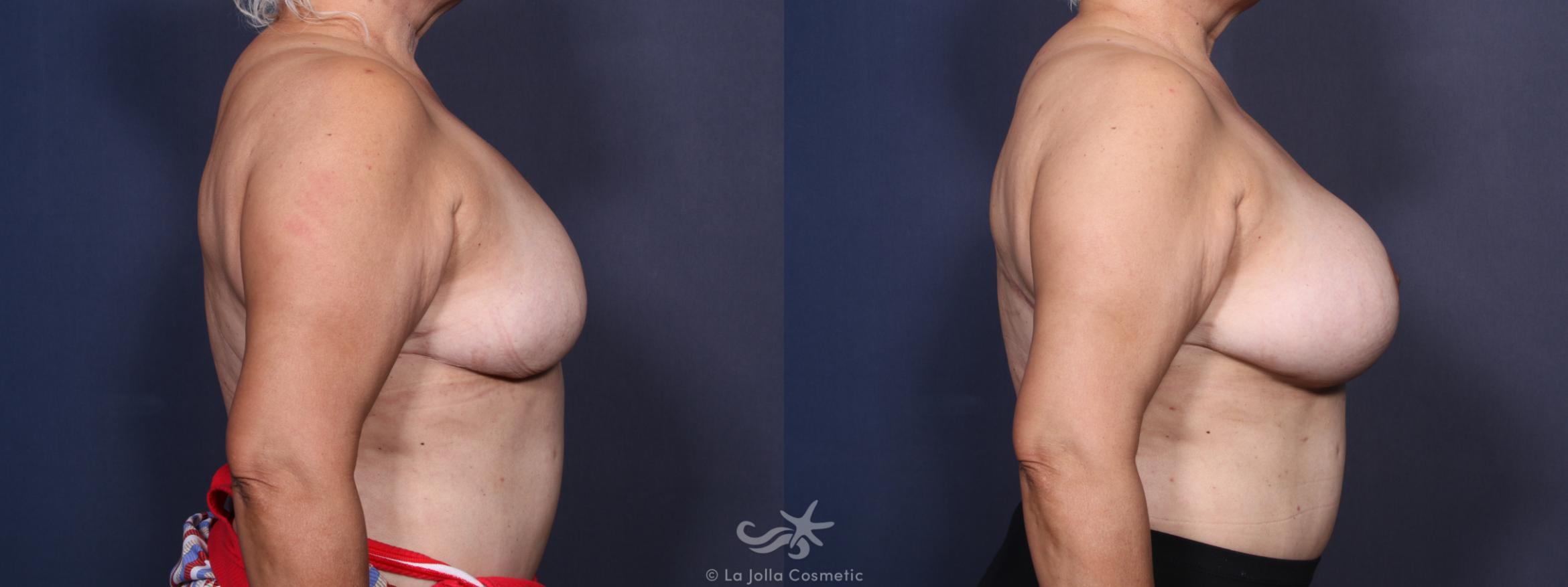 Before & After Breast Augmentation Revision Result 92 Right Side View in San Diego, CA