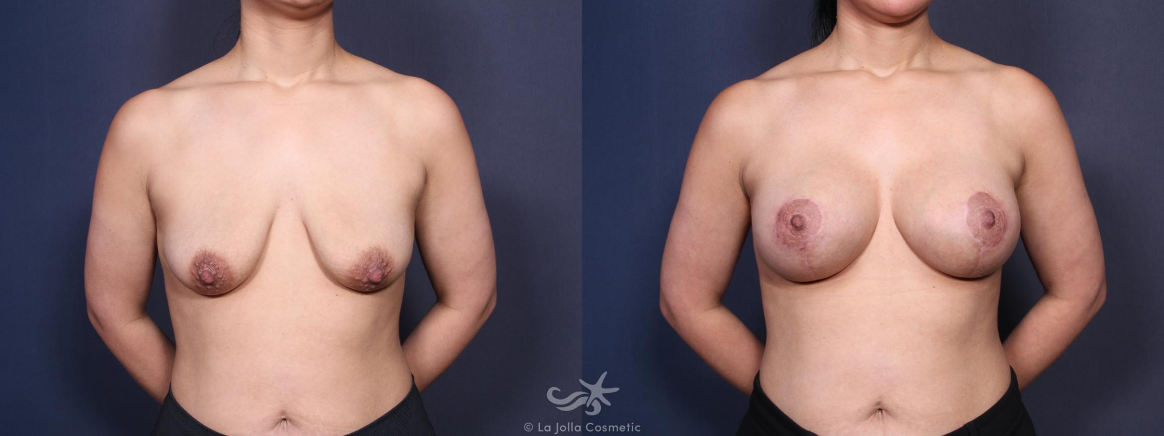 Before & After Breast Augmentation with Lift Result 103 Front View in San Diego, CA