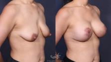 Before & After Breast Augmentation with Lift Result 139 Right Oblique View in San Diego, Carlsbad, CA