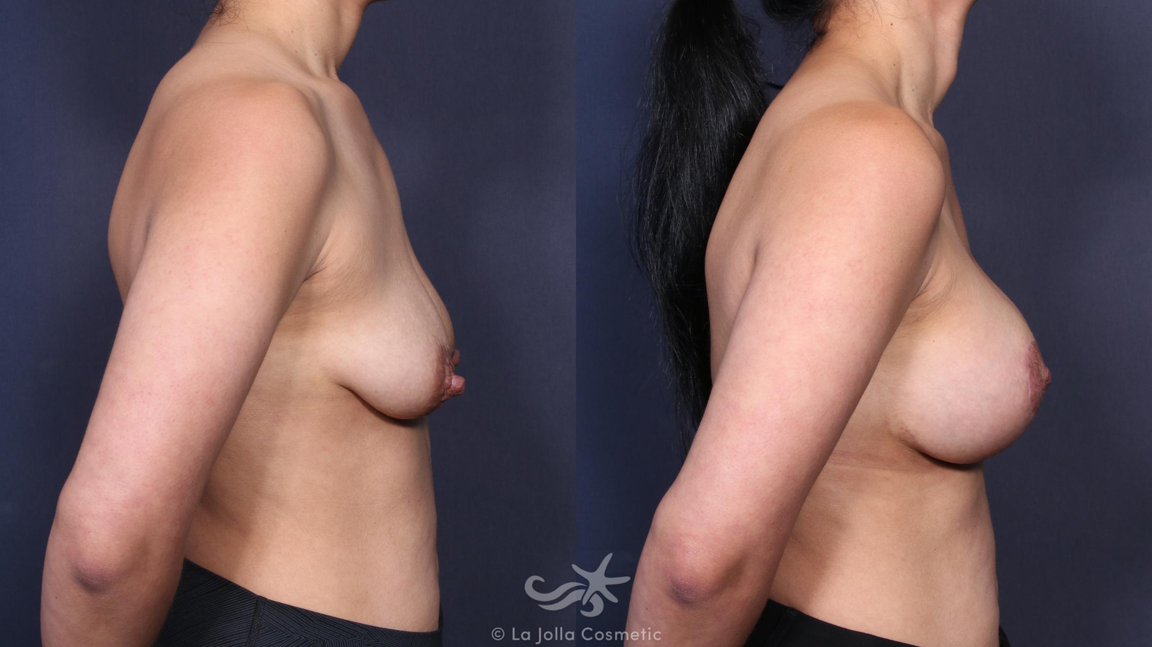 Before & After Breast Augmentation with Lift Result 139 Right Side View in San Diego, CA