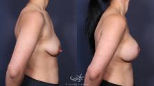Before & After Breast Augmentation with Lift Result 139 Right Side View in San Diego, Carlsbad, CA