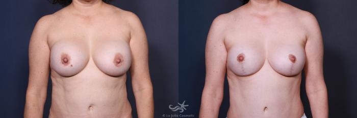 Before & After Breast Augmentation Result 15 Front View in San Diego, Carlsbad, CA