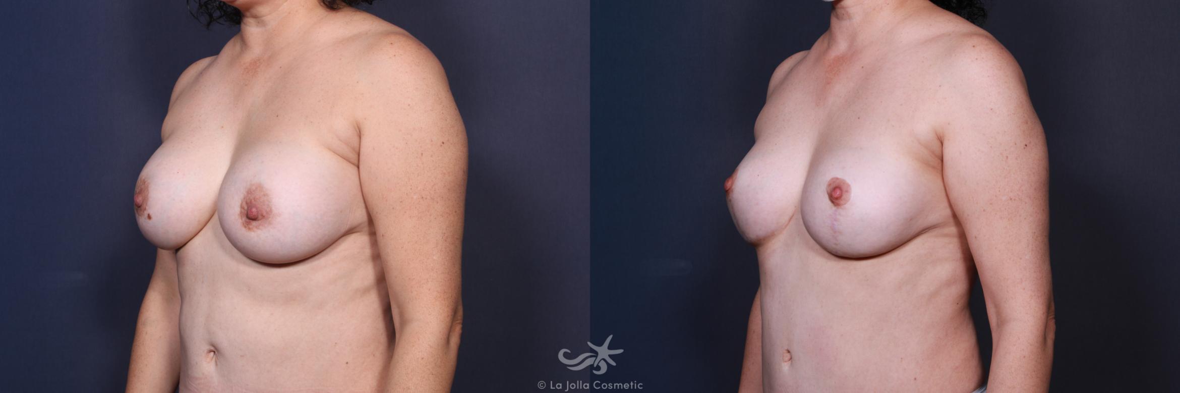 Before & After Breast Augmentation with Lift Result 15 Left Oblique View in San Diego, CA
