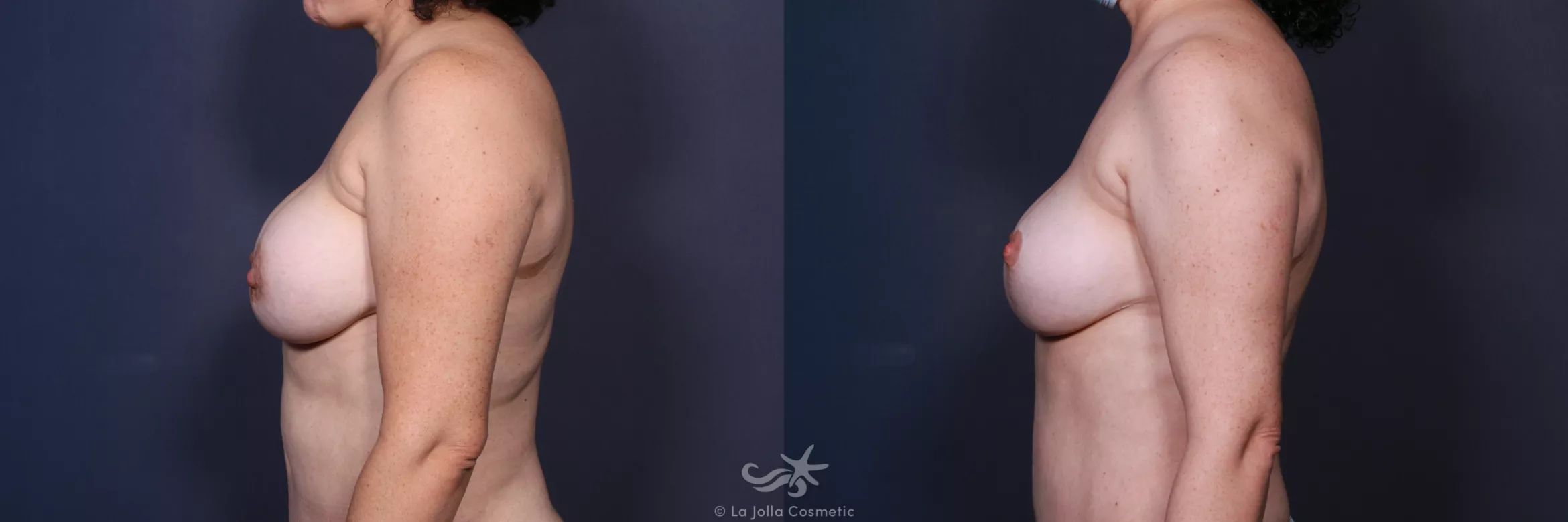 Before & After Breast Augmentation with Lift Result 15 Left Side View in San Diego, CA