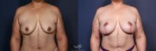 Before & After Breast Augmentation with Lift Result 162 Front View in San Diego, Carlsbad, CA