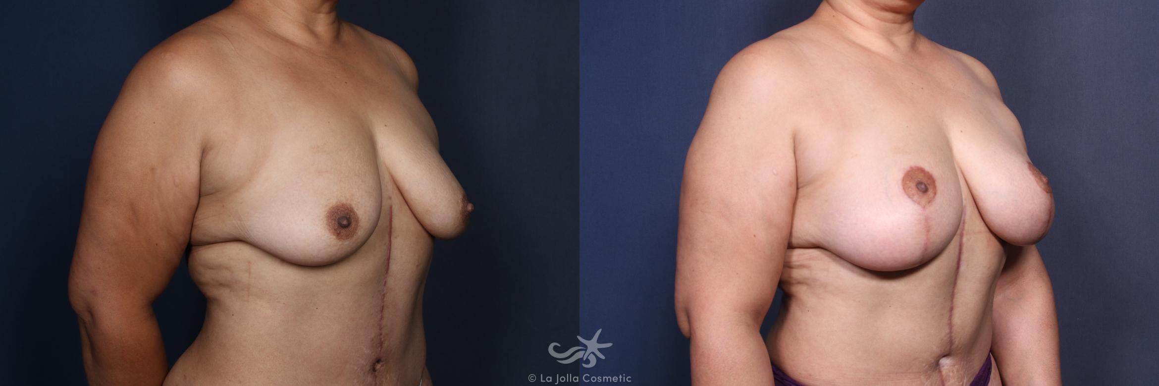 Before & After Breast Augmentation with Lift Result 162 Left Oblique View in San Diego, CA