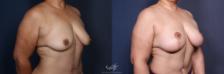 Before & After Breast Augmentation with Lift Result 162 Left Oblique View in San Diego, Carlsbad, CA