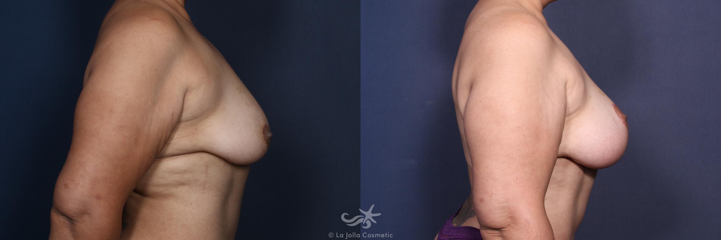 Before & After Breast Augmentation with Lift Result 162 Left Side View in San Diego, CA