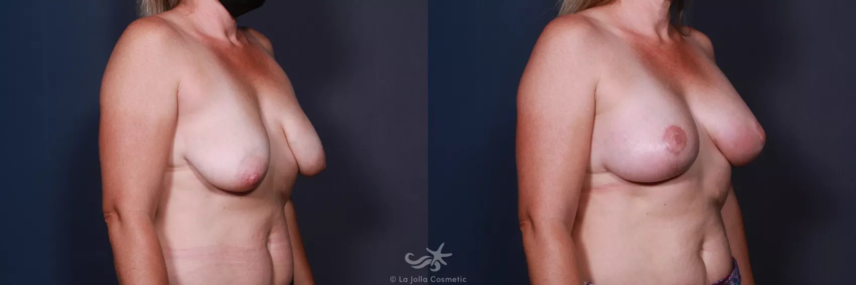Before & After Breast Augmentation with Lift Result 189 Right Oblique View in San Diego, CA