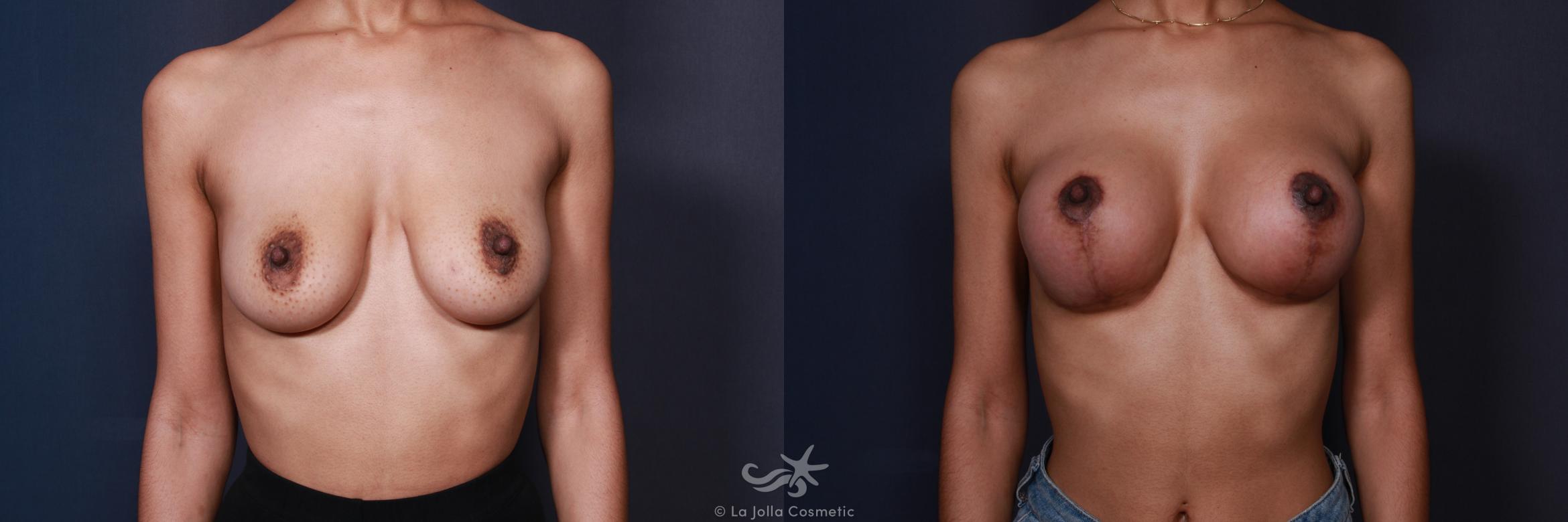 Before & After Breast Augmentation with Lift Result 202 Front View in San Diego, CA