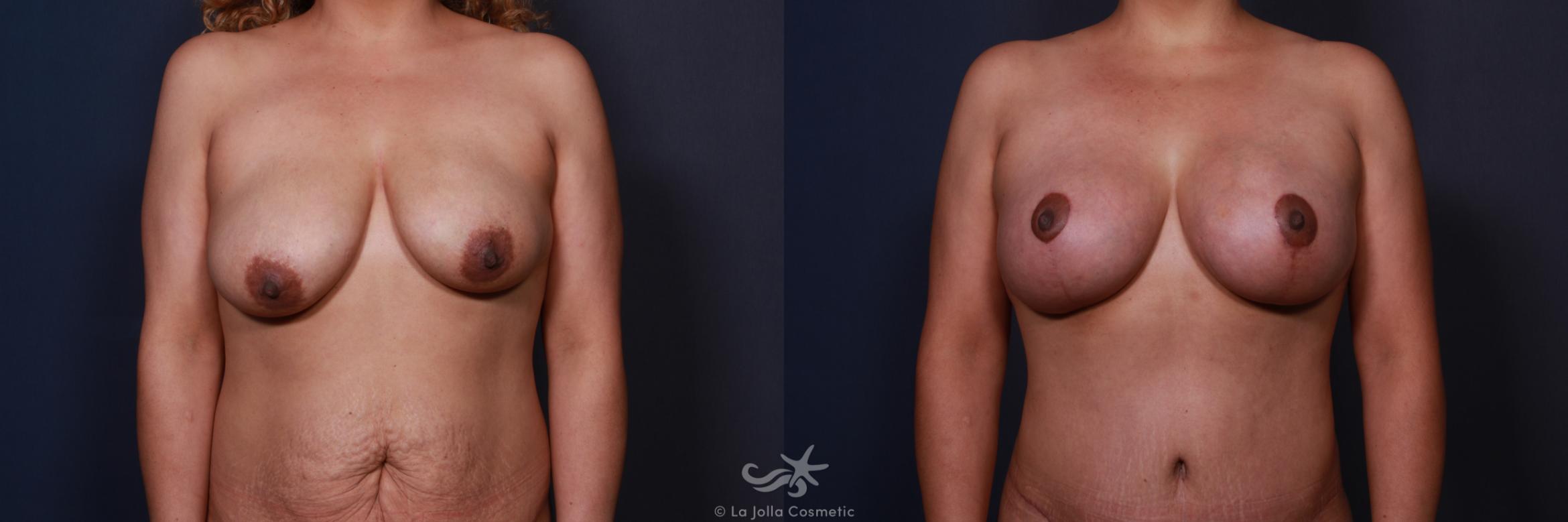 Before & After Breast Augmentation with Lift Result 203 Front View in San Diego, Carlsbad, CA