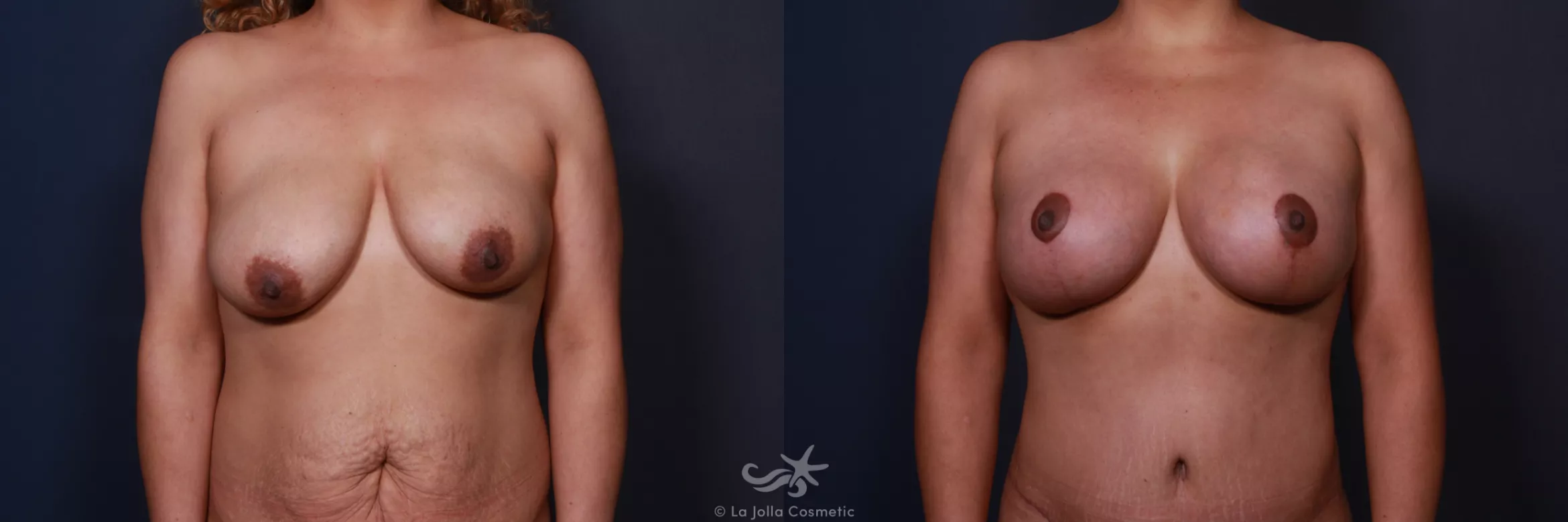 Before & After Breast Augmentation with Lift Result 203 Front View in San Diego, CA