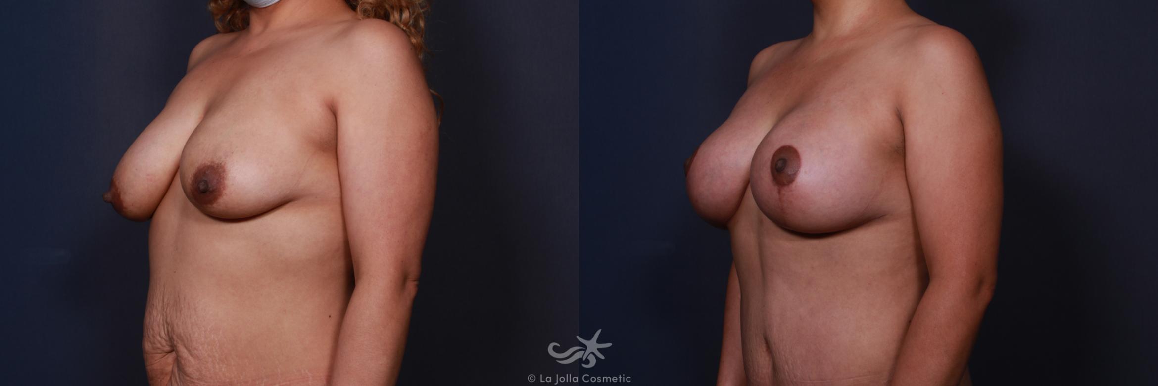 Before & After Breast Augmentation with Lift Result 203 Left Oblique View in San Diego, CA