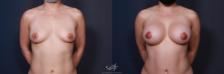 Before & After Breast Augmentation with Lift Result 213 Front View in San Diego, Carlsbad, CA