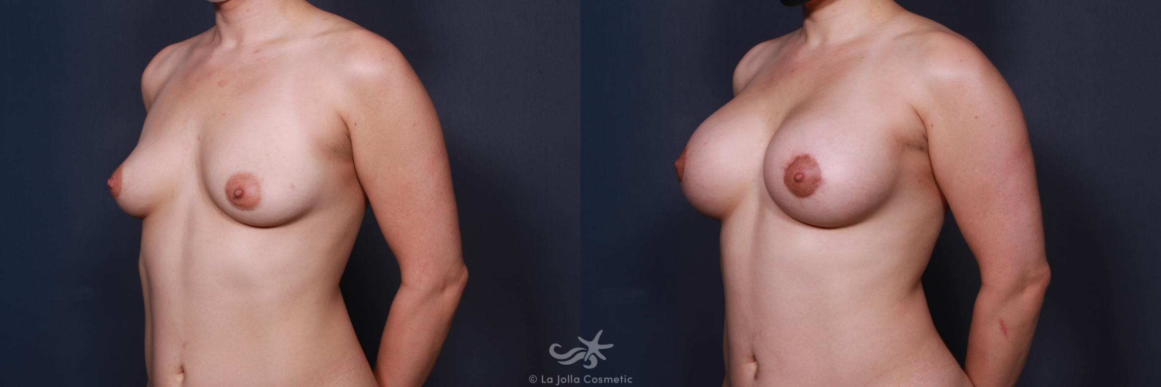 Before & After Breast Augmentation with Lift Result 213 Left Oblique View in San Diego, CA
