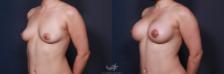 Before & After Breast Augmentation with Lift Result 213 Left Oblique View in San Diego, Carlsbad, CA