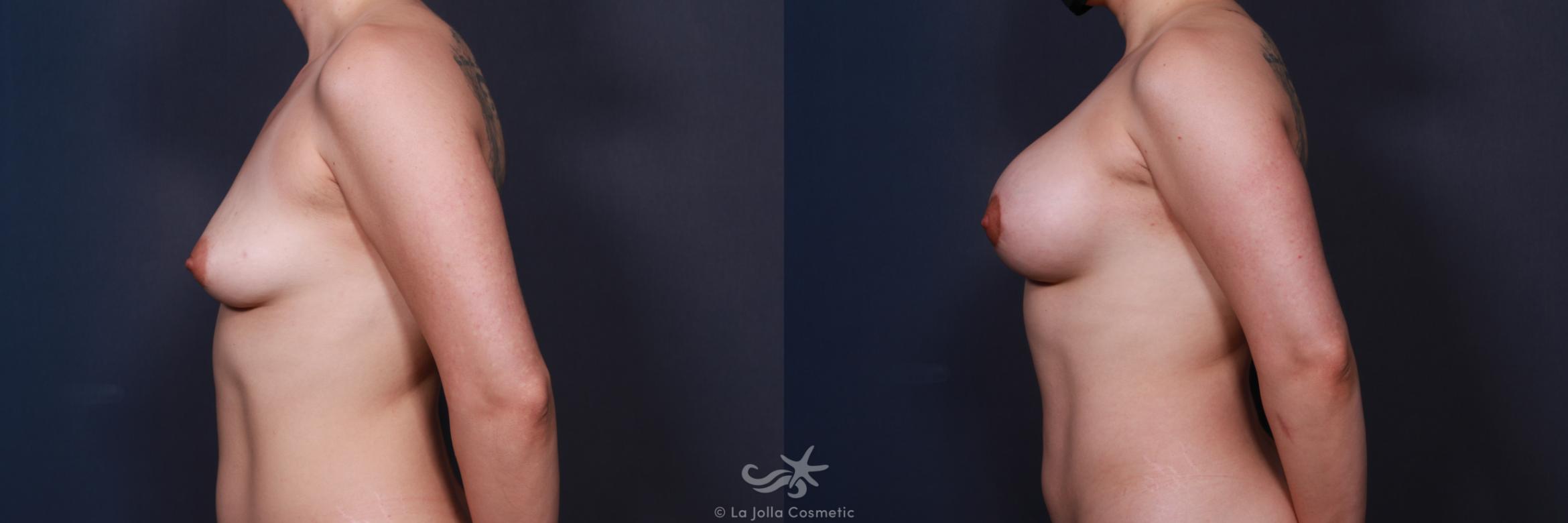 Before & After Breast Augmentation with Lift Result 213 Left Side View in San Diego, CA