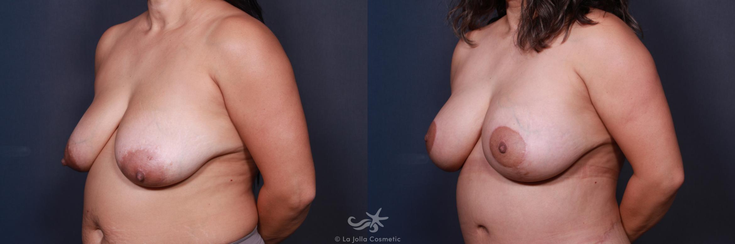 Before & After Breast Augmentation with Lift Result 219 Left Oblique View in San Diego, CA