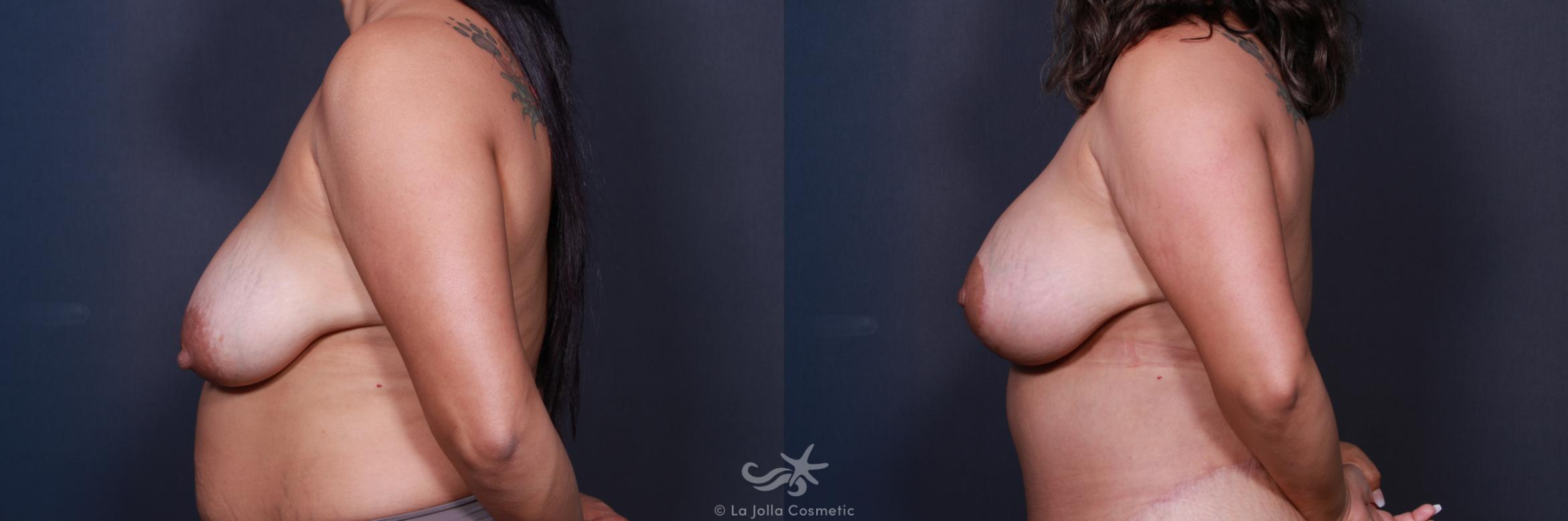 Before & After Breast Augmentation with Lift Result 219 Left Side View in San Diego, CA