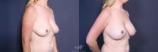 Before & After Breast Augmentation with Lift Result 223 Right Oblique View in San Diego, Carlsbad, CA