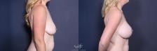 Before & After Breast Augmentation with Lift Result 223 Right Side View in San Diego, Carlsbad, CA