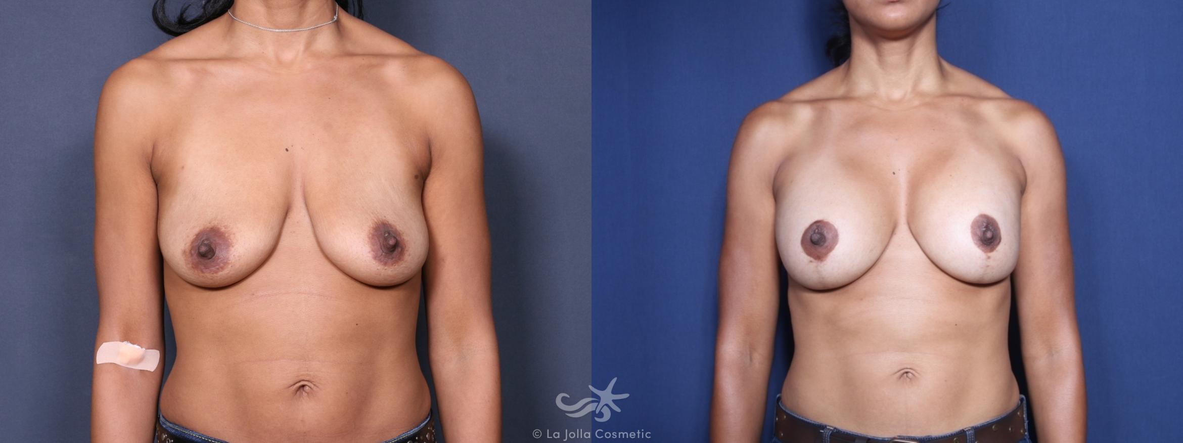 Before & After Breast Augmentation with Lift Result 229 Front View in San Diego, CA