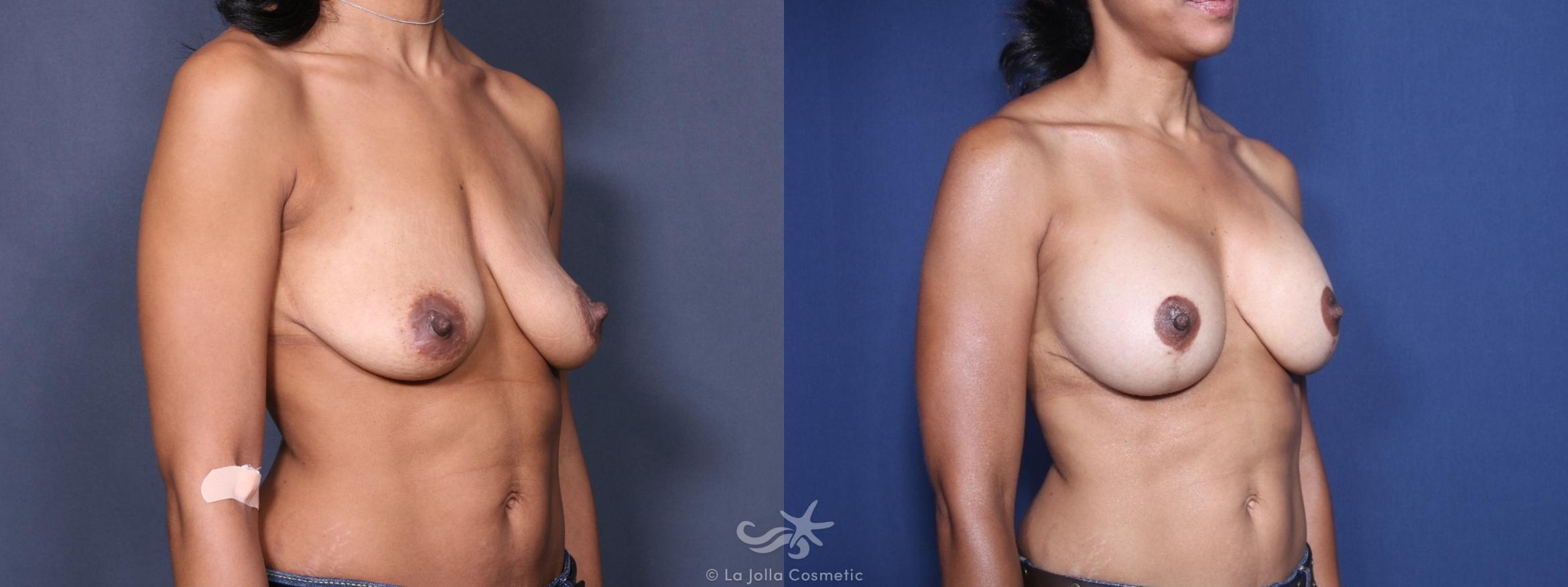 Before & After Breast Augmentation with Lift Result 229 Right Oblique View in San Diego, CA