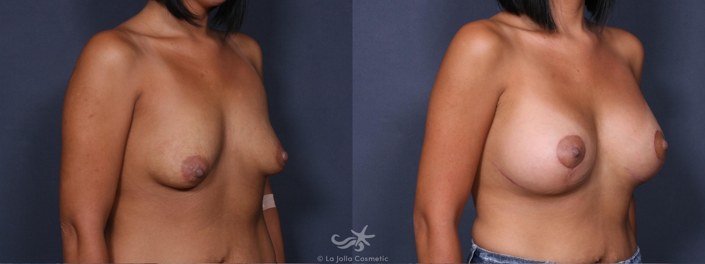 Before & After Breast Augmentation with Lift Result 299 Right Oblique View in San Diego, CA