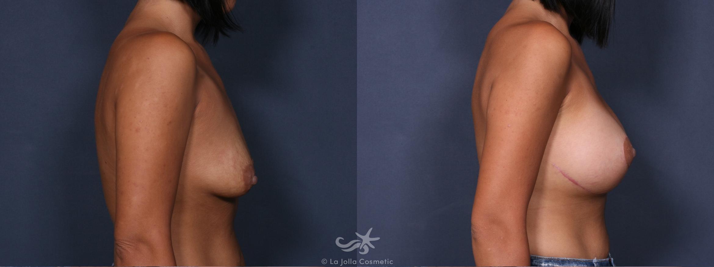 Before & After Breast Augmentation with Lift Result 299 Right Side View in San Diego, CA