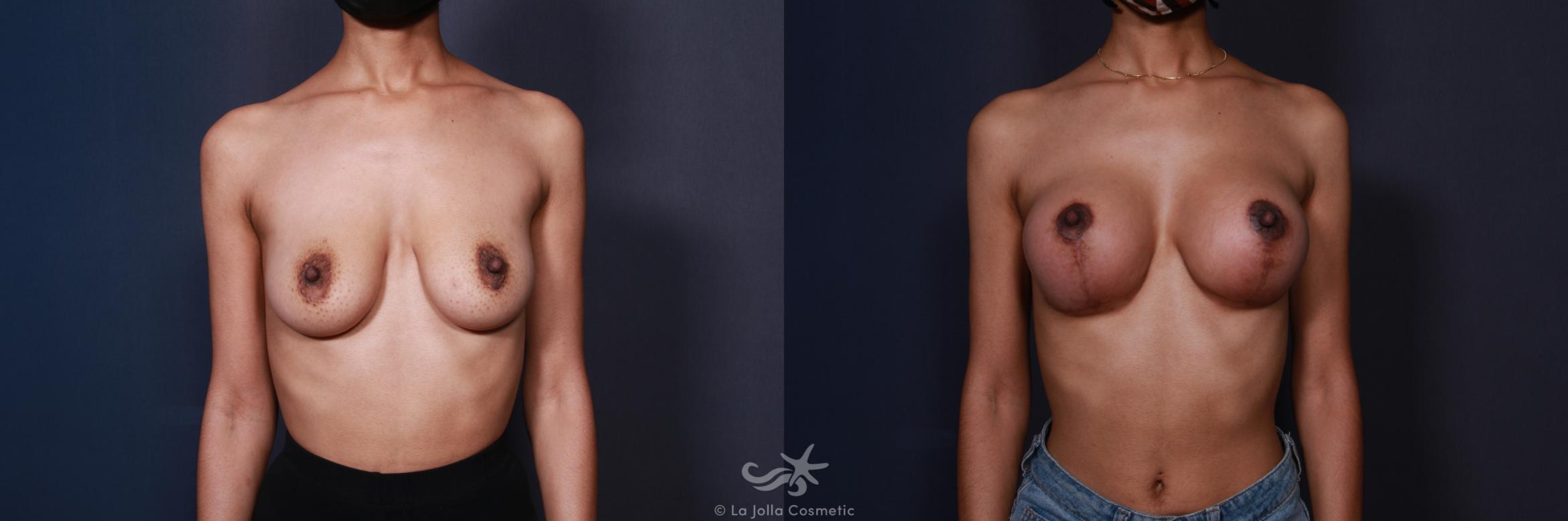 Before & After Breast Augmentation Result 3 Front View in San Diego, CA