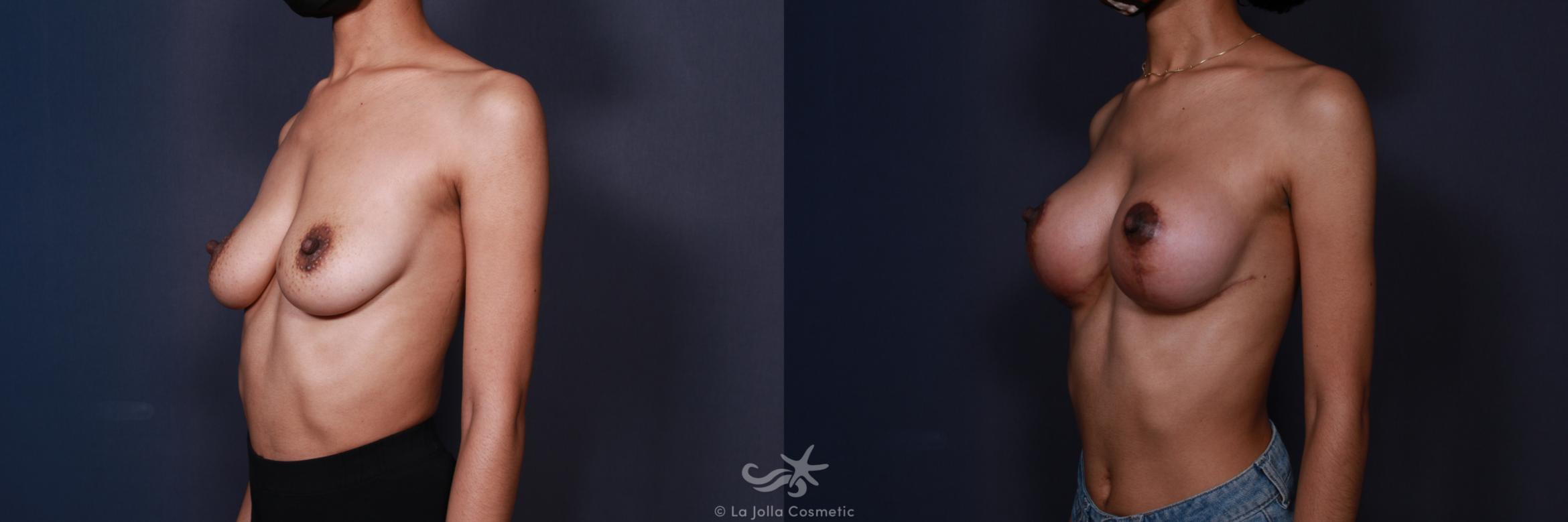 Before & After Breast Augmentation with Lift Result 3 Left Oblique View in San Diego, CA
